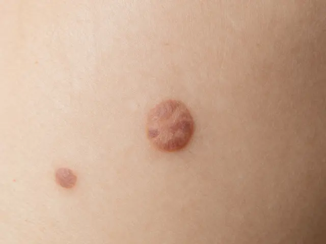 Jak často chodit na kontrolu znamének? Aktuální doporučení pro rok 2026