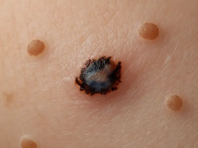 Jak vypadá špatně znaménko? Pravidlo ABCDE a varovné signály